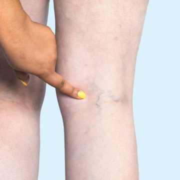 Endovenous-Laser