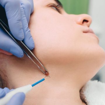 procedure removing mole. radio wave electrocoagulation method